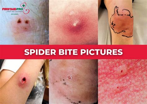 Common Spider Bites On Humans