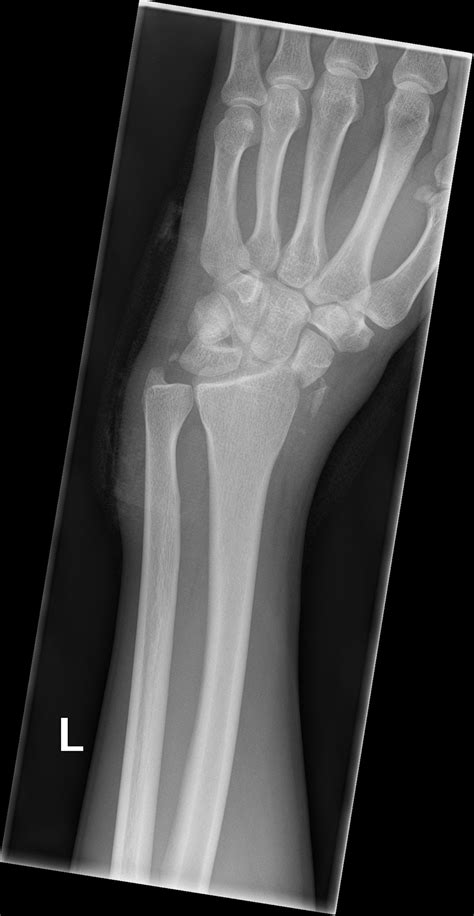 Trans-scaphoid perilunate fracture-dislocation | Image ...