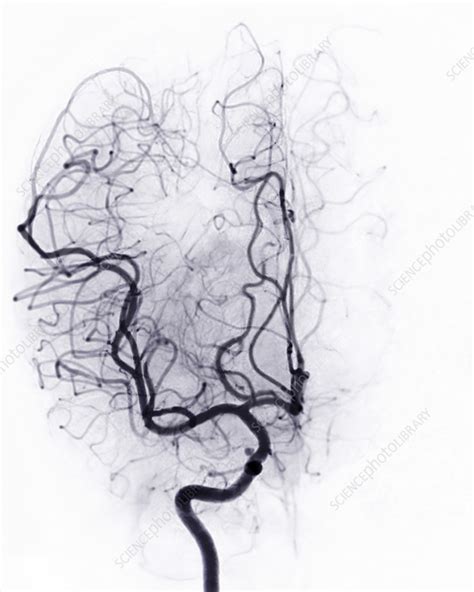 Cerebral Arteries Angiogram Stock Image F0377075 Science Photo