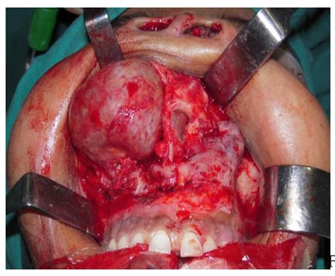 Midfacial Degloving Approach for Bilateral Giant Cell Reparative ...
