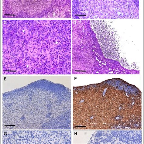 Representative Histological And Immunohistochemical Findings Of Lymph