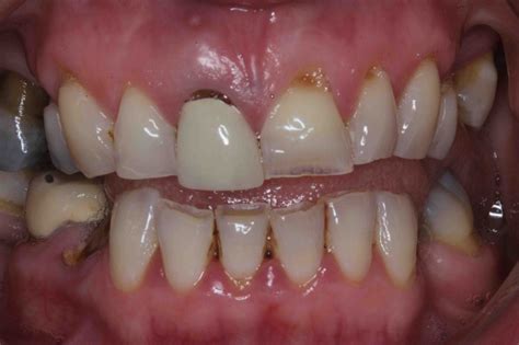Dental Implants Before And After Photos Lane Ends Dental Practice Preston