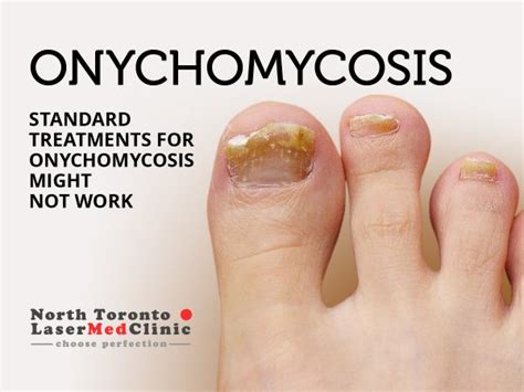 Standard Treatments For Onychomycosis Might Not Work North Toronto