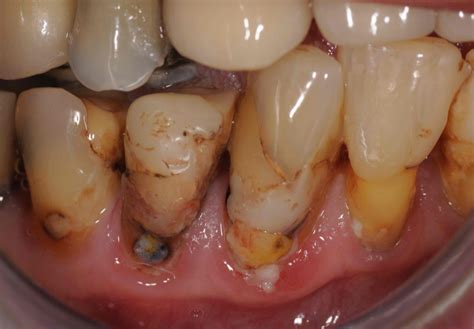 Polyphenols And Oral Health Dentistryiq