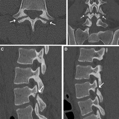 Bilateral L4 Pars Defect Arrows On Computed Tomography Ct A