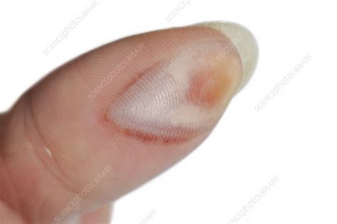 Burn To The Thumb Stock Image C0215594 Science Photo Library