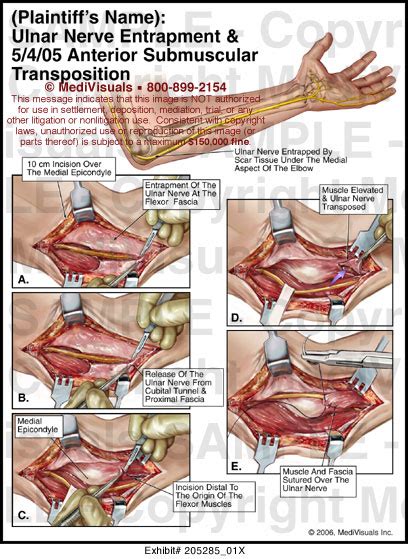 Ulnar Nerve Entrapment And Anterior Submuscular Transposition