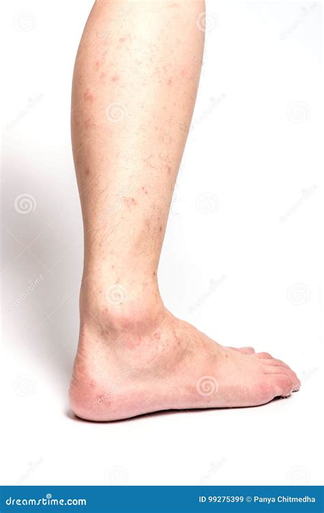 Contact Dermatitis Rash On Legs