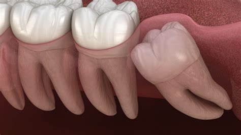does everyone have to get their wisdom teeth out boston dentist congress dental group 160