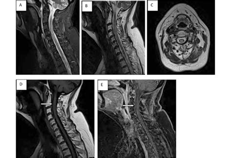 Cervical Spine Mri With Letm Stir And Sagittal And Axial T2 Flair A C