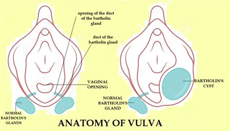 bartholin s abscess vs bartholin s cyst symptoms and treatment jmsh