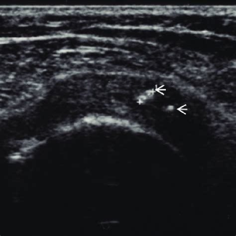 A Partial Thickness Tear Of The Achilles Tendon Longitudinal Sonogram