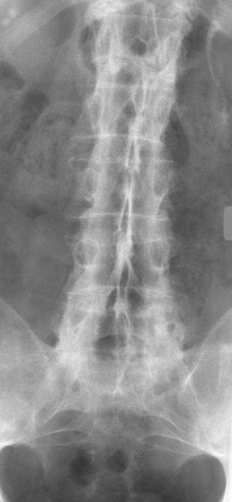 Ankylosing Spondylitis X Ray Wikidoc