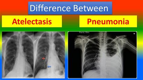 Atelectasis Vs Pneumonia Chest X Ray Sexiezpicz Web Porn