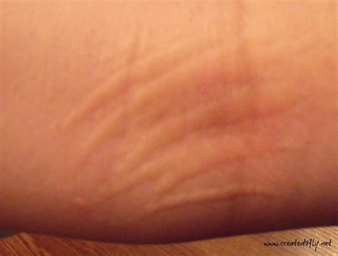 The Gray Area Stop The Itch Of Contact Dermatitis