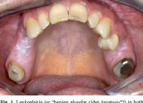 Pdf Oral Leukoplakia The Ongoing Discussion On Definition And