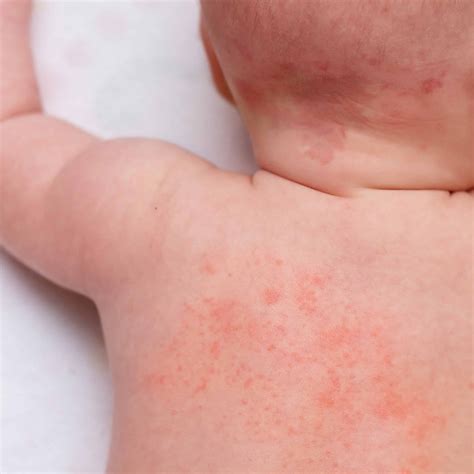 Ketahui Penyebab Dan Jenis Bintik Merah Pada Bayi Morinaga Soya