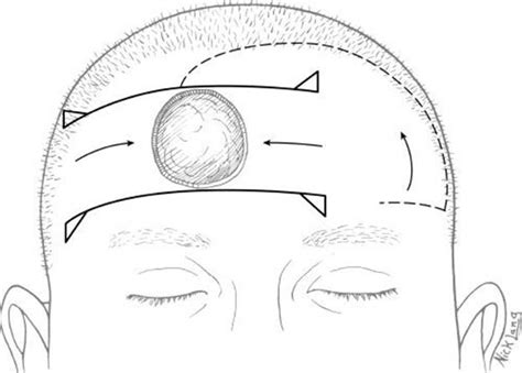 Reconstruction Of The Scalp Calvarium And Forehead Grabb And Smith