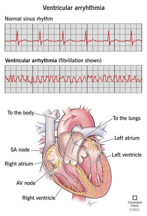 ventricular arrhythmia causes symptoms and treatment