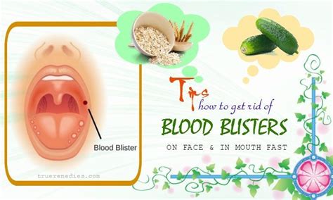 36 Tips How To Get Rid Of Blood Blisters On Face And In Mouth Fast