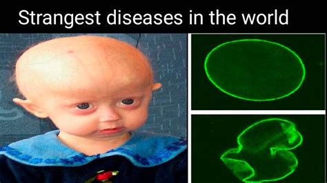 Strangest Diseases In The World Rarest Disease In The World YouTube