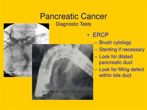 Ppt Periampullary And Pancreatic Tumors Powerpoint Presentation Id