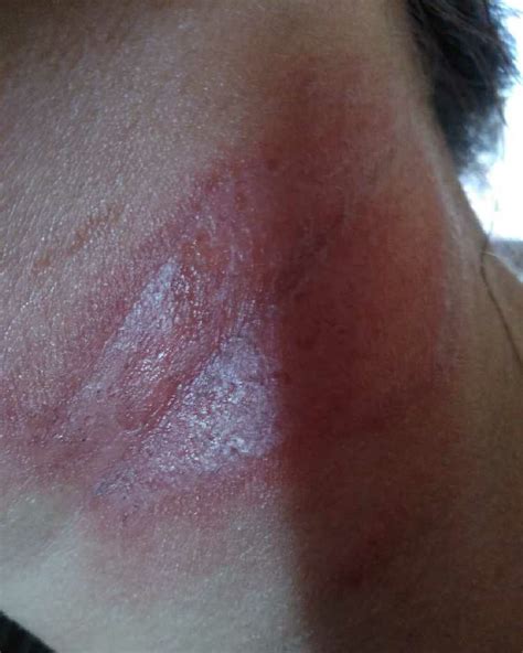 Seven Months Pregnant And Have Got Red Burning Patch Like Rash On Neck