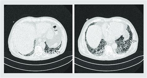 Follow Up Chest Ct Scan Showing Extensive Lung Fibrosis With Multiple