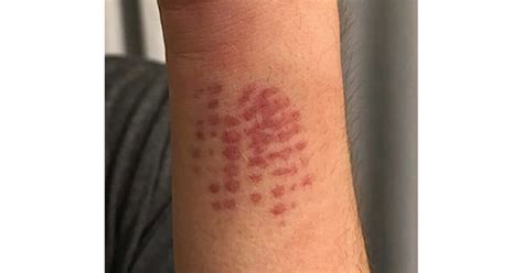 Sick Teen Complains Of Strange Red Mark On His Arm Mom Has Warning