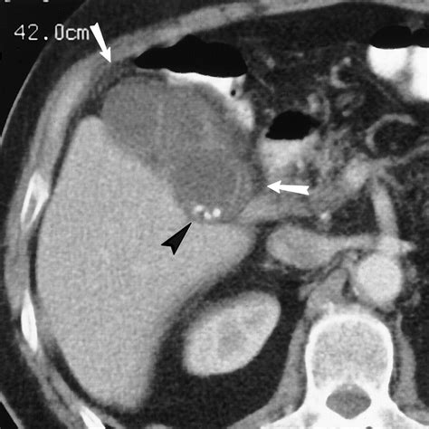 Gallbladder Stones Imaging And Intervention Radiographics