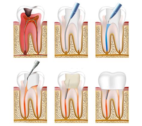 Tratamento endodôntico para preservar seu dente natural