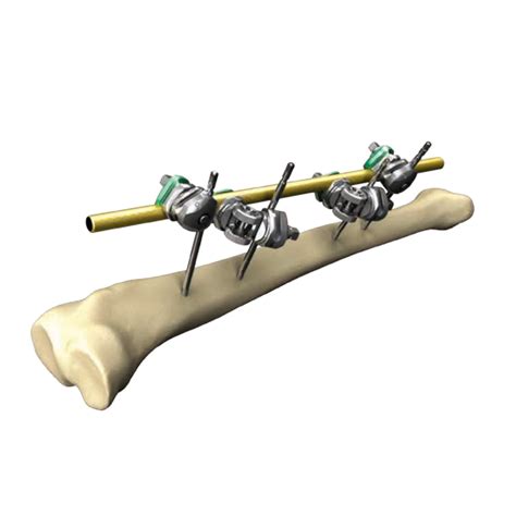Clinical podiatric medicine and surgery 20: Hoffman 3 External Fixation | Joint Medical Products ...