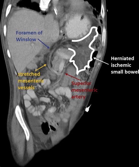 Foramen Of Winslow Internal Hernia Surgery