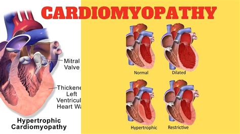 What Is Cardiomyopathy