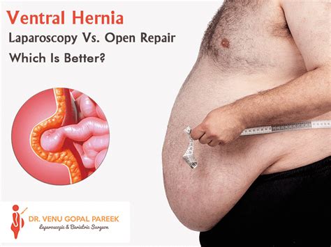 Care guide for incisional hernia. Ventral Hernia -Laparoscopy Vs. Open Repair Which Is Better?