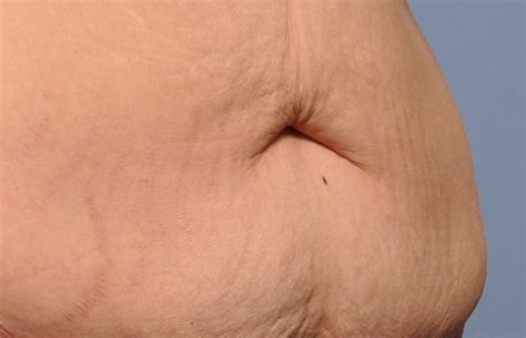 Eppley Tummy Tuck Belly Button Before Explore Plastic Surgery