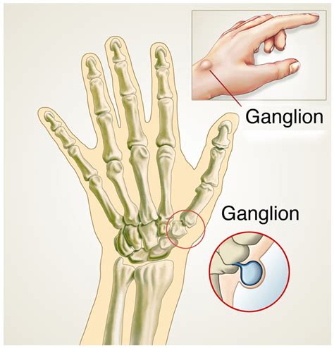 Jak Wyleczy Ganglion Choroby Polki Pl