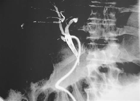 Intraoperative Cholangiogram Showing The Flow Of Contrast Into The