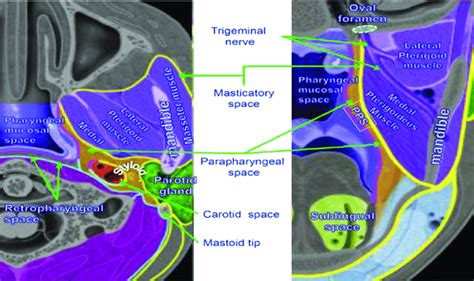 Parapharyngeal Space Transversal And Coronal Sections Download