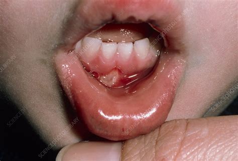 Aphthous Ulcer In A Child Mouth Stock Image M2800134 Science