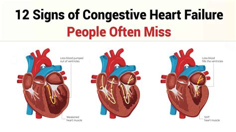 Congestive Heart Failure In The Elderly A Tw