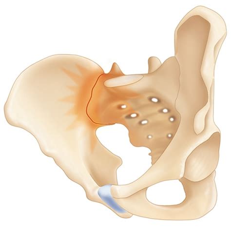 Minimally Invasive Sacroiliac Joint Fusion Globus Medical