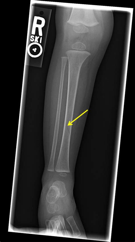 Toddler Fracture Radiologypicscom