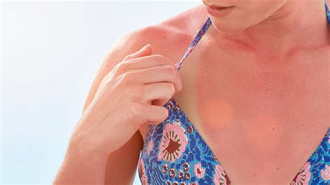Sun Poisoning What To Do When You Think Your Sunburn Isn T Just A