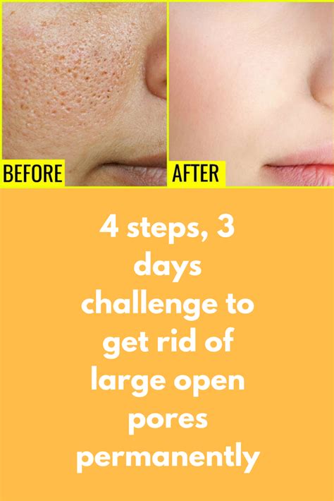 Steps Days Challenge To Get Rid Of Large Open Pores Permanently If You Are Suffering From