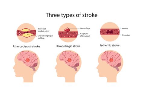 Different Types Of Strokes