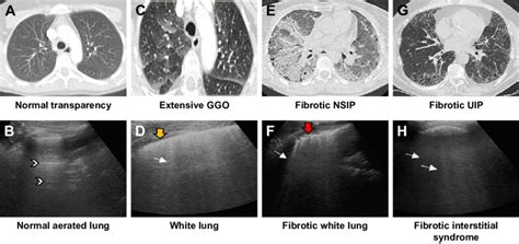 Hrct Lus Correlation In Normal Lung Pulmonary Congestion Rheumatoid