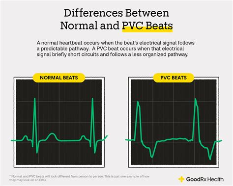 What It Means If You Have Premature Ventricular Contractions Pvcs On