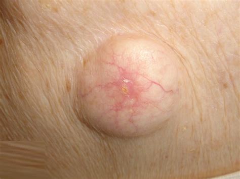 Epidermoid Cyst Medical Pictures Info Health