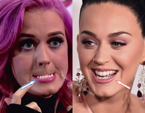 Katy Perry Before And After